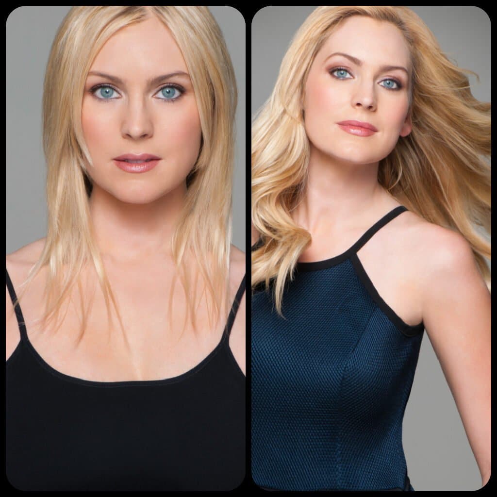 Before and after photos of blond hair replacement procedure