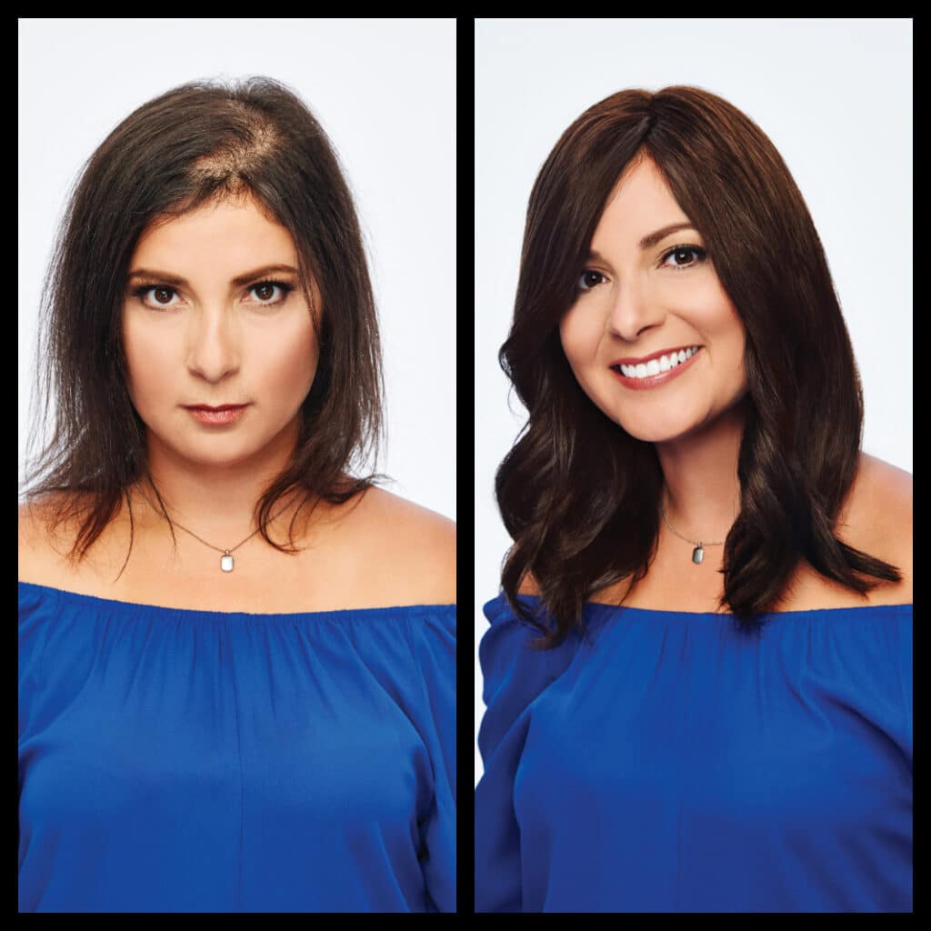 Before and after photos of elite model hair replacement procedure