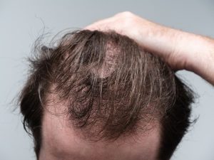 Close-Up Of A Person Holding Their Hair Back Showing Clear Signs Of A Receding Hairline And Hair Loss